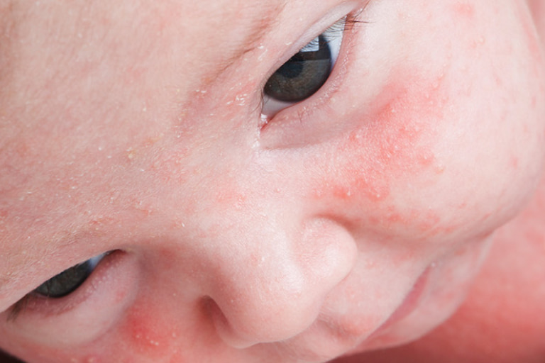Common Newborn Skin Rashes and Bumps | Huggies®
