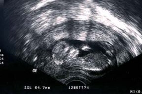 What expect at a 12 week ultrasound | US