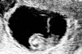What to Expect at a 7 Week Ultrasound | Huggies® US